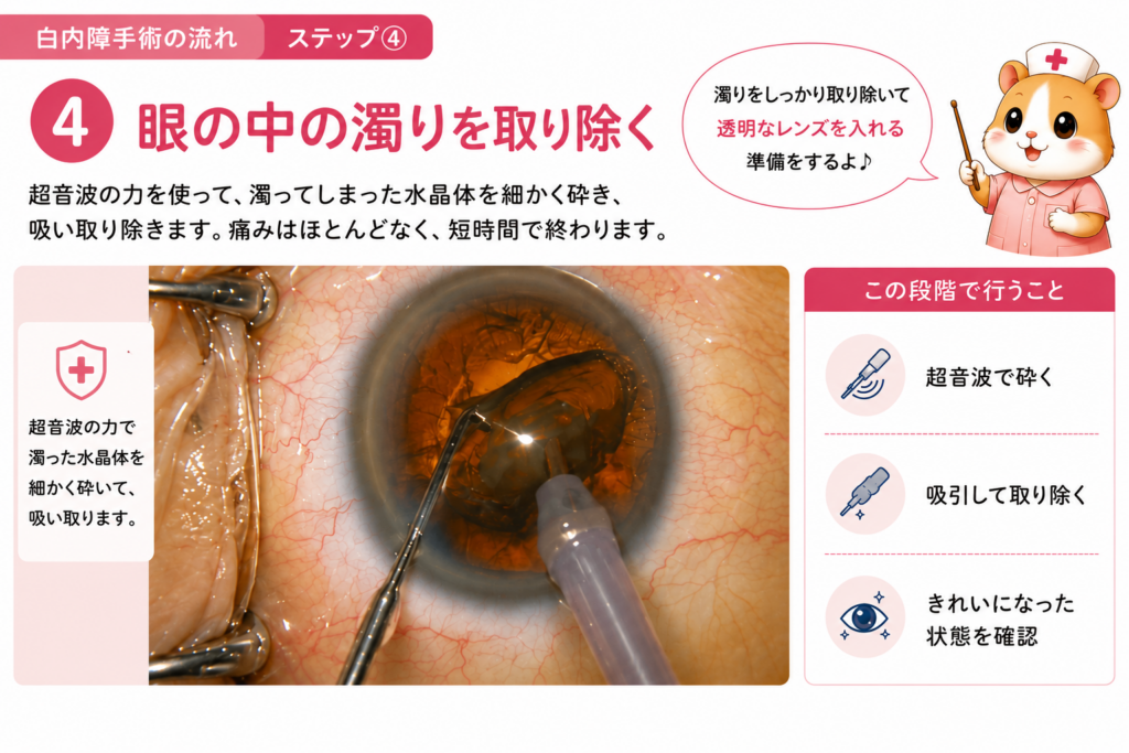 * 白内障手術で超音波乳化吸引術(PEA)を行い、濁った水晶体を細かく砕いて吸引・除去する工程をわかりやすく解説した画像