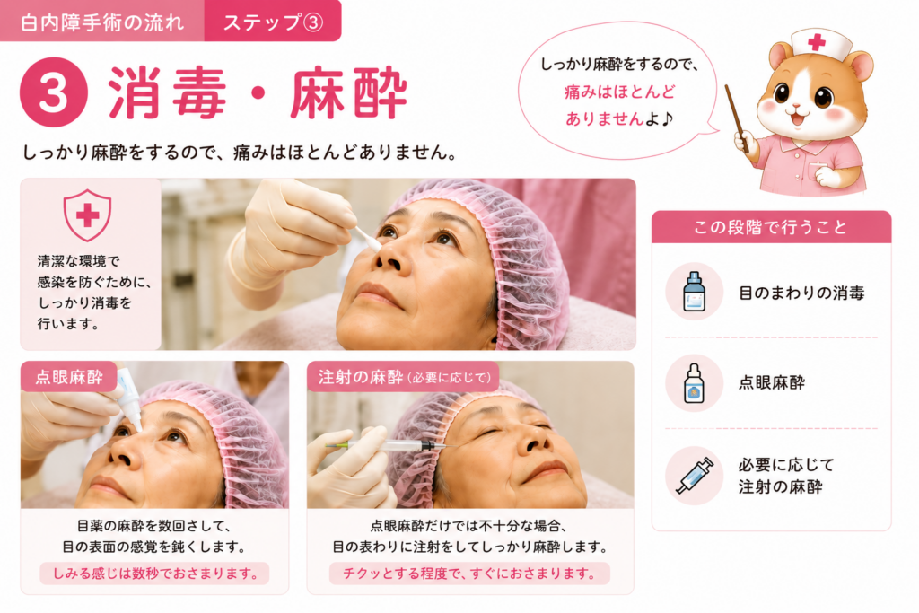 白内障手術前の消毒と麻酔を解説した図解。目のまわりの消毒、点眼麻酔、必要に応じた注射麻酔など、手術前の準備の流れをわかりやすく紹介した画像。