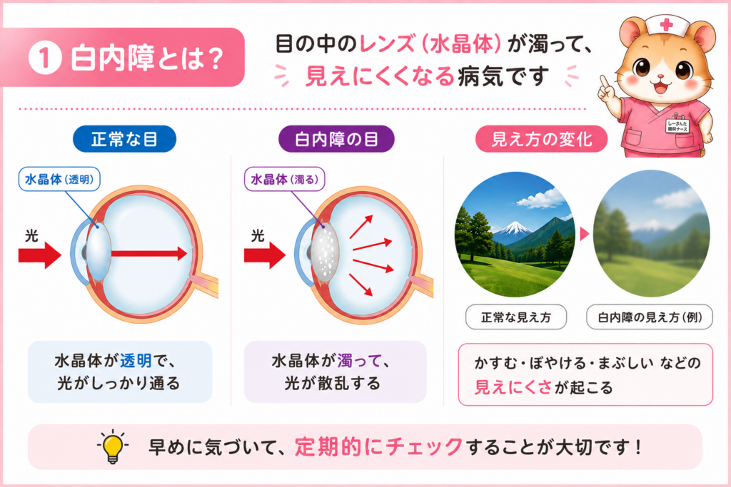 白内障とは、水晶体が濁って光が通りにくくなり、正常な目との見え方の違いや変化する仕組みをわかりやすく解説した図解
